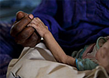 重度の栄養不良の子ども© UNICEF Chad/2011/ Estev